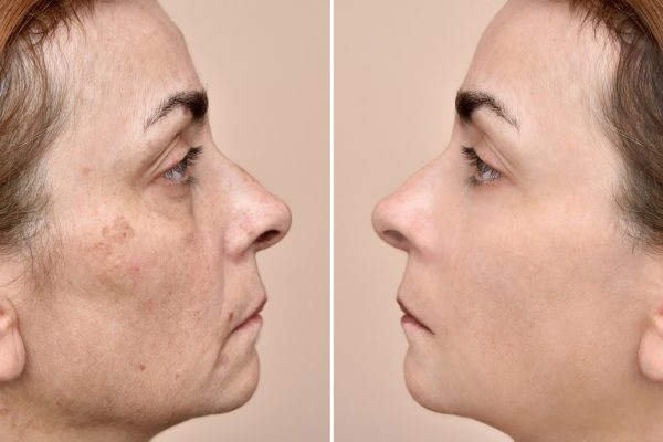 Woman before and after applying make-up and removing eye bags